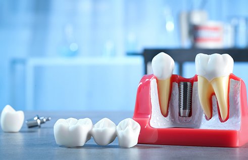 Model dental bridge and dental implants on gray surface 