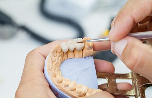 Hands holding model jaw and customizing dental bridge