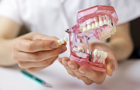 Hands holding model jaw with 2 implants to support a bridge