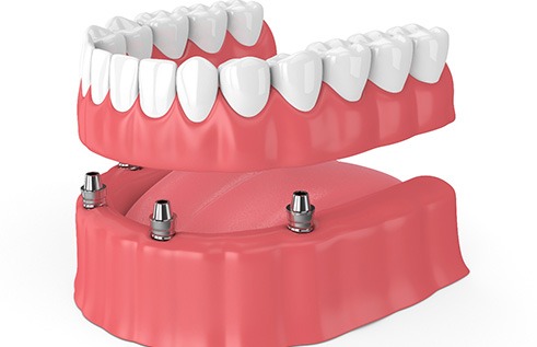 Illustration of lower arch of implant dentures with white background