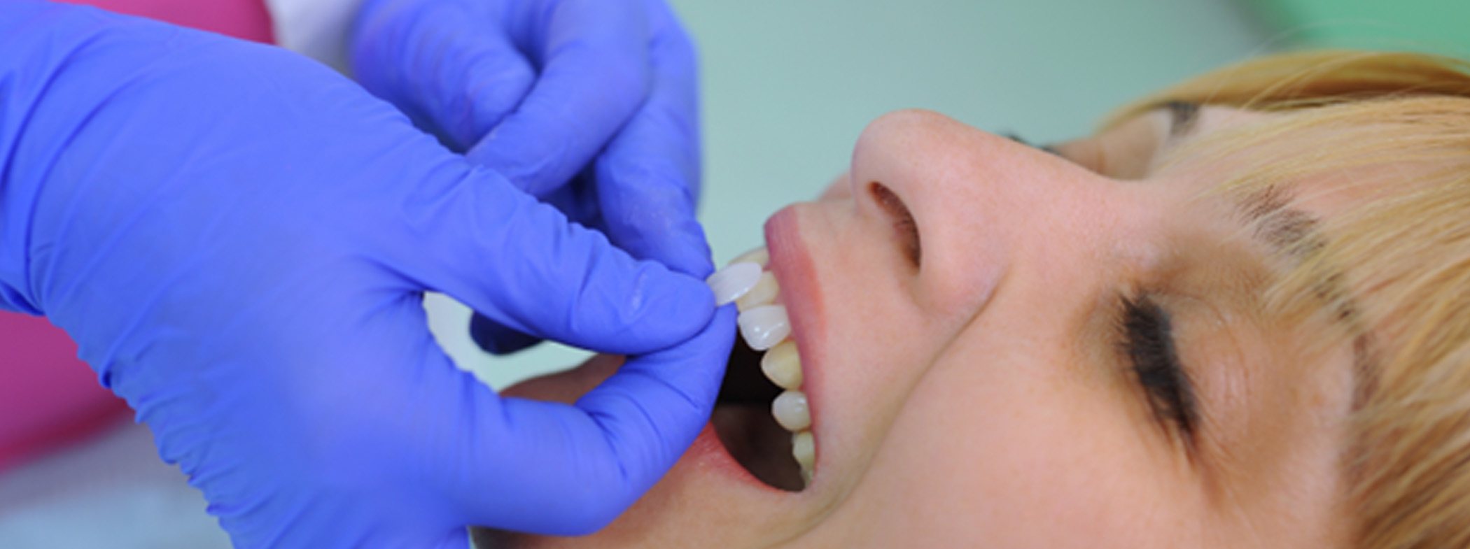 a dentist placing a veneer on a patient’s tooth