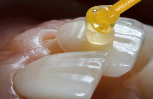 a close-up of a veneer being placed on a tooth