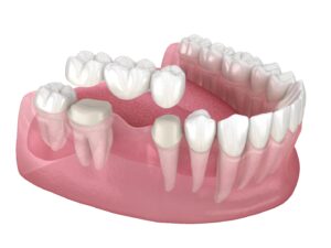 Digital image of dental bridge.